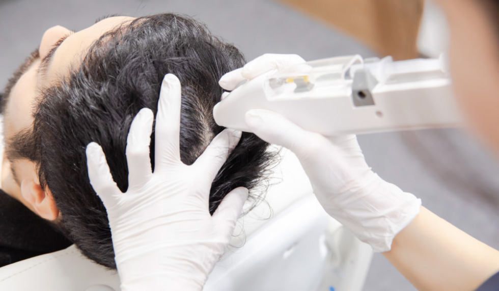 Dr.AGAクリニックのメソセラピー「超発毛メソ治療」の画像