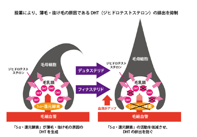 投薬により、薄毛・抜け毛の原因であるDHTの排出を抑制