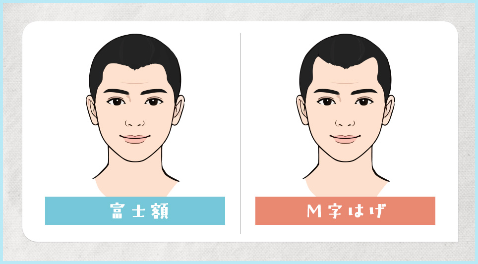 富士額とM字ハゲの違いの図説