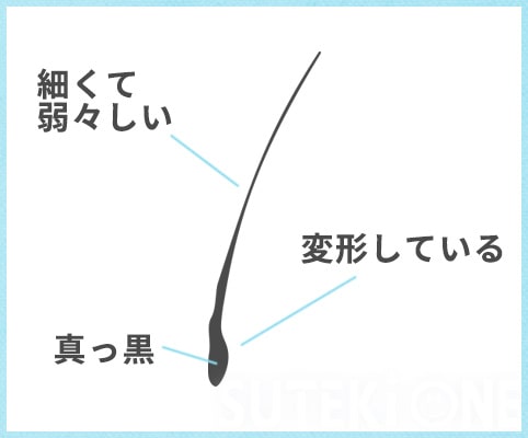 AGAを発症している抜けでの図説
