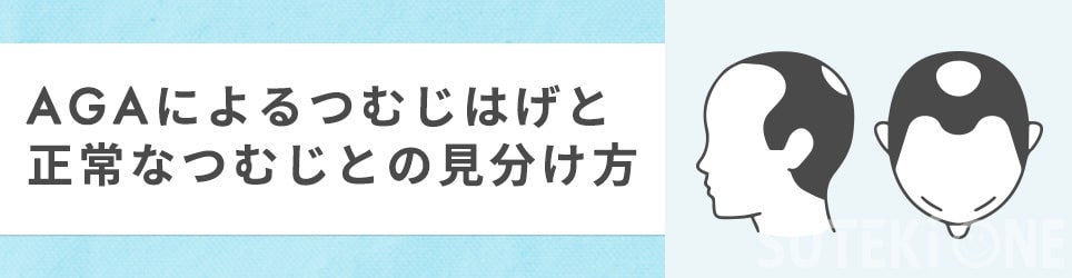 通常のつむじとつむじはげの見分け方