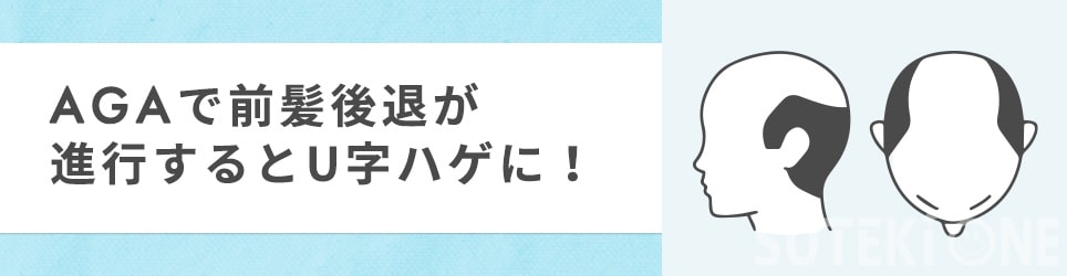 U字はげについて