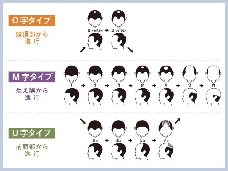 ハミルトンノーウッド分類からM・O・U字ハゲの区分け