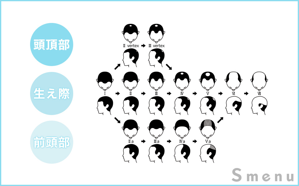 高島分類のイラスト