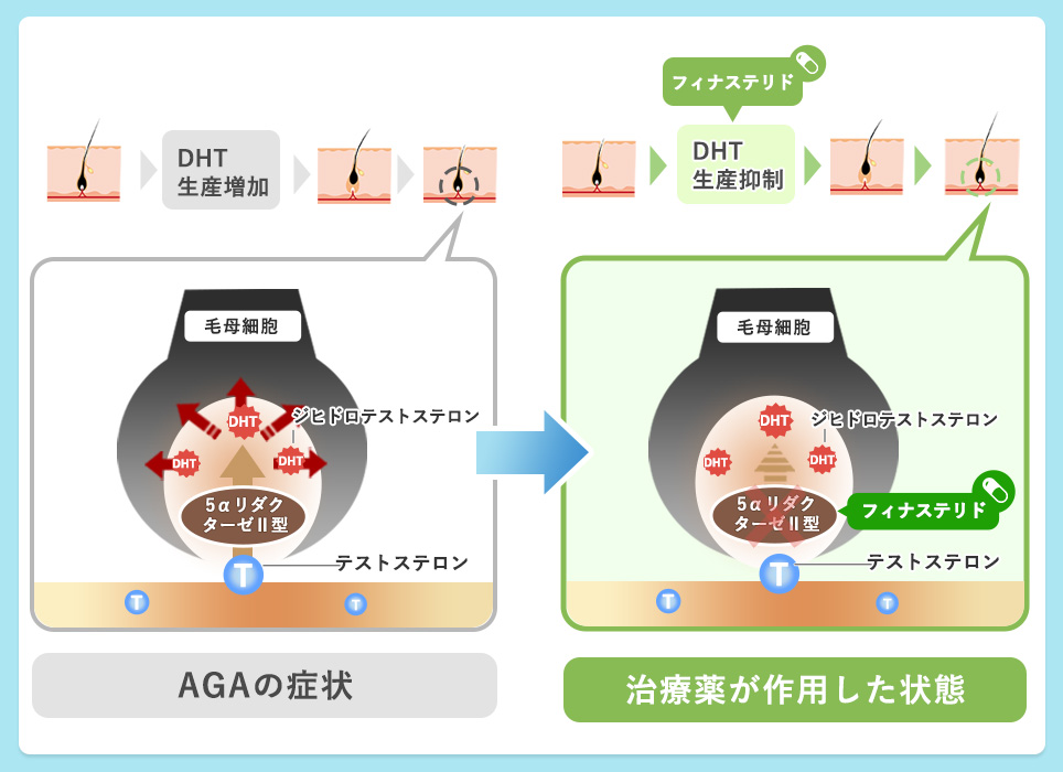 フィナステリドの効果